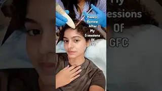 My experience with GFC for my female pattern hairloss! MUST WATCH🤭