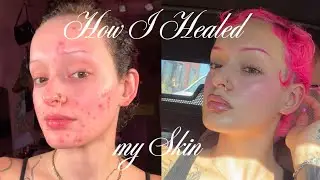 how i cleared my acne & healed my skin 