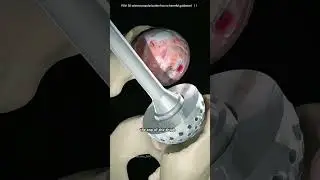 How Superpath Hip Replacement Surgery Is Performed (3D Animation)#hipsurgery#superpathhipsurgery