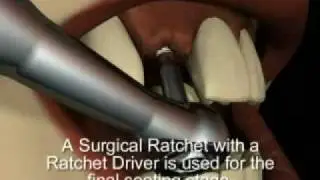 Mini Dental Implants - Intra-Lock International's MILO
