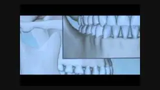 using BiteFX to expalin Anterior Guidance to Patients