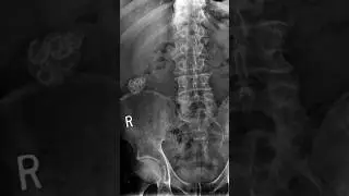 Radiographic appearance of Gallstones #xray #gallstones #radiology