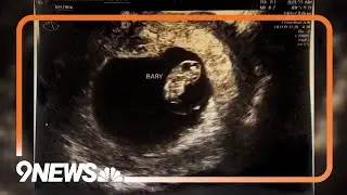 Doctors perform brain surgery on a baby in womb