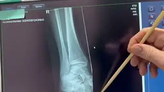 Ankle Series Film Critique