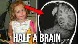 The Incredible Case of 2 Girls Living with HALF a Brain