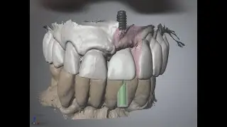 CAD CAM dentale
