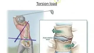 Motion segment of Lumbar spine - anterior part