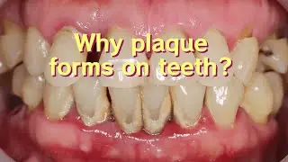 Why plaque forms on teeth? || reason for plaque formation  #dentalplaque #dentist #dental