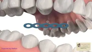TAD for Over-Erupted Molar - Wellington Village Orthodontics