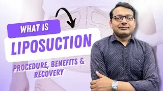 Liposuction Explained: What It Is & The Real Side Effects You Should Know!