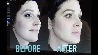 Rhinoplasty | 3D Imaging | Khoobehi & Associates
