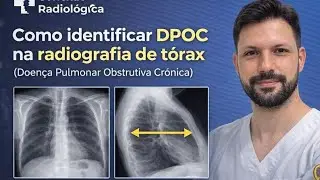 COMO IDENTIFICAR DPOC NO RAIO-X DE TÓRAX. DOENÇA PULMONAR OBSTRUTIVA CRÔNICA.  