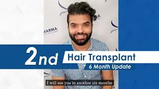 2nd Hair Transplant 6 Month Update