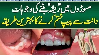 Dant Mein Resha Ka ilaj - Dant Mein Infection Ka ilaj - How to Cure Tooth Abscess Naturally