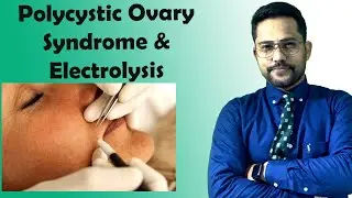 Polycystic Ovary Syndrome Electrolysis, HOW TO REMOVE FACIAL HAIR PERMANENTLY