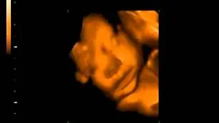 Reading PA 3D 4D Ultrasound