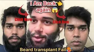 I am back again beard transplant boy | Fail 🥵 | Journey