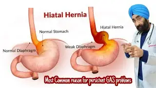 What is Hiatus Hernia - symptoms & treatment explained in Hindi | Dr.Education