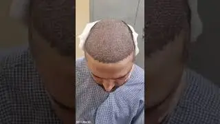 hair transplant 3 months result #hairstyle #hairlosstreatment #dhi