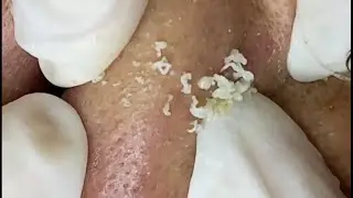 How to get acne and bruise blood in nose treatament