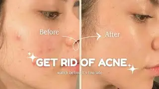 From Acne to Clear Skin ✨ | The Ultimate Guide You NEED to See