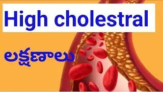 High cholesterol lakshanalu ||Mana Health