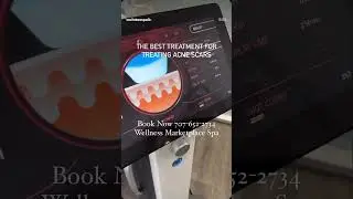 RF Microneedling with CO2 laser for scar and acne treatment