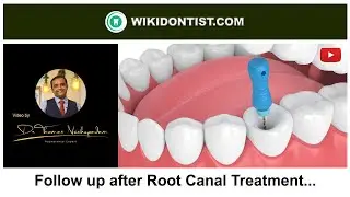 Follow up after Root Canal Treatment... Video by Dr.Thomas Nechupadam