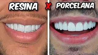 LENTES DE RESINA x LENTES DE PORCELANA