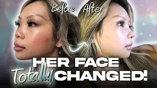 Her Ultimate Glow-Up 😱✨ | Em's plastic surgery journey at Braun! (Part 1)