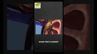 Kidney Stone Surgery Explained | Minimally Invasive Laser & Scope Techniques by Dr. Manish Dubey