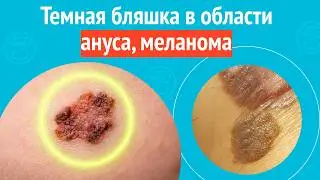Dark plaque in the anal area, melanoma. Case report #1719