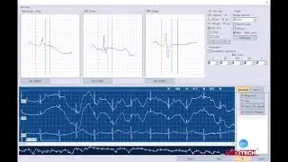 check how to use Meditech Holter ECG Heartrec ECO Pro and Lite model Part1