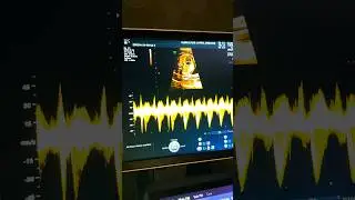 What Does Baby's Heartbeat Sound Like?