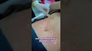 reshape cold plasma for stretch marks