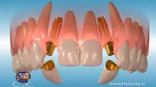 Laterals Implant