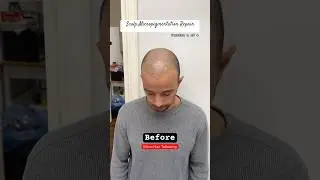 Scalp Micropigmentation Repair #smp #scalpmicropigmentation #smptraining #hairtransformation