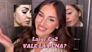 VI RACCONTO LA MIA ESPERIENZA CON IL LASER CO2 PER LE MACCHIE E CICATRICI DA ACNE….LO RIFAREI?