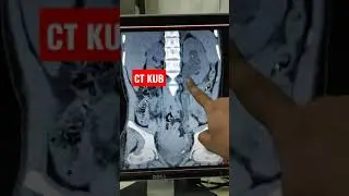 КТ почек и мочевыводящих путей - простая КТ почек и мочевыводящих путей при наличии камней и гидр...