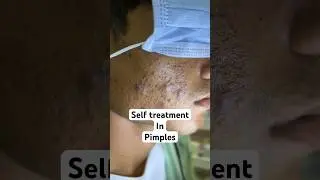 Best tips for acne treatment #acnetreatment #skincareclinic #bhopal acne treatment in bhopal