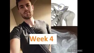 ROAD TO RECOVERY - Distal clavicle excision surgery | WEEK 4