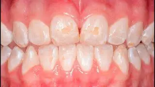 ¿Qué es la hipoplasia del esmalte y cómo tratarla?