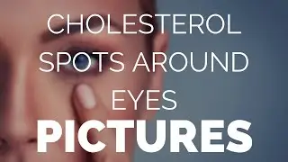 Cholesterol spots around eyes pictures @ xanthel.com