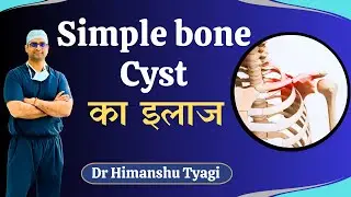 Simple Bone Cyst का इलाज |
