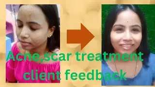 Acne, scar, dark spot treatment.#hair #best #beauty #makeup #online