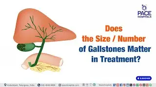 Does the Size/Number of Gallstones Matter in Treatment? | Do gallstone size/number affect treatment?