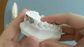 What different types of crown materials look like
