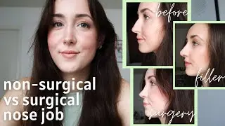 Non-Surgical vs Surgical NOSE JOB | Before & After