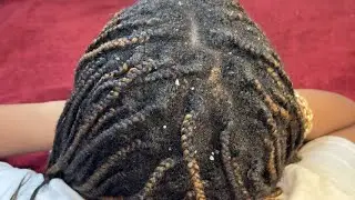 ASMR Scalp Scratching Session | Dry, Flaky Scalp • Comb, Fingernails & Massage Tool