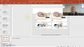 NUR 360: Chapter 22 (Prolapsed Cord, Uterine Rupture)
